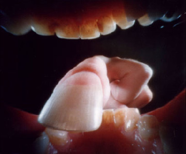 stenope bouche3 Justin Quinnell se met un stenopé dans la bouche