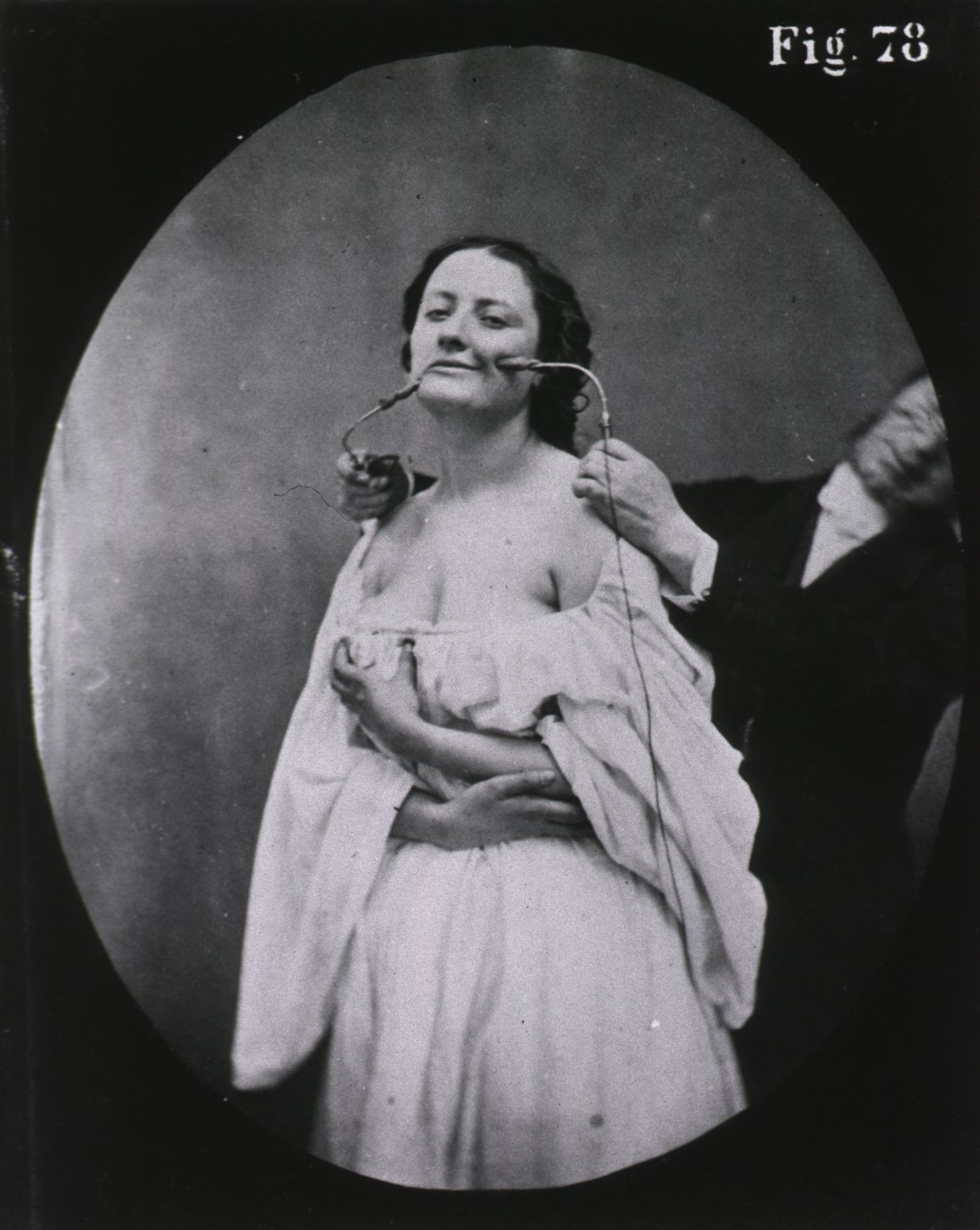 Les expressions électriques du visage par Duchenne de Boulogne expression visage electricite Duchenne Boulogne 06 expression visage electricite Duchenne Boulogne 06 Les expressions électriques du visage par Duchenne de Boulogne technologie photographie histoire featured