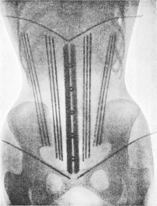radio-corset-05