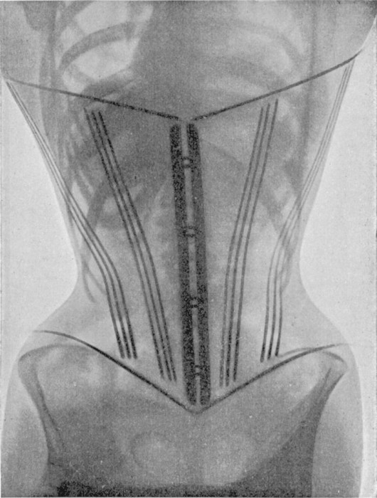 radio-corset-06