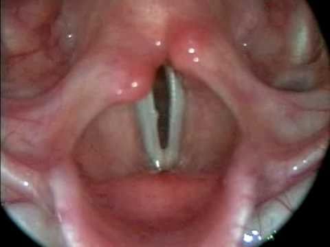 Regardez des cordes vocales