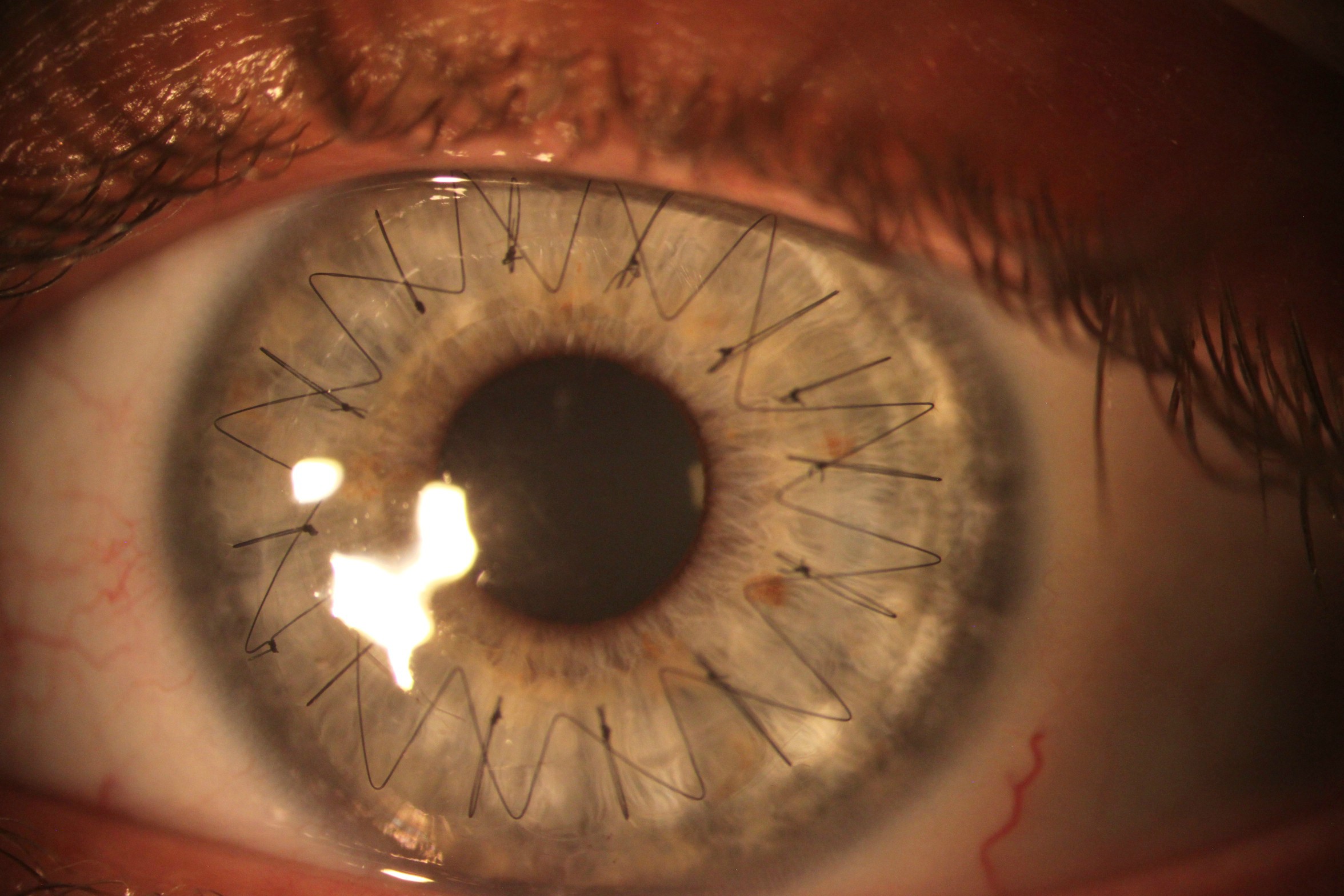 Des points de suture dans l’oeil