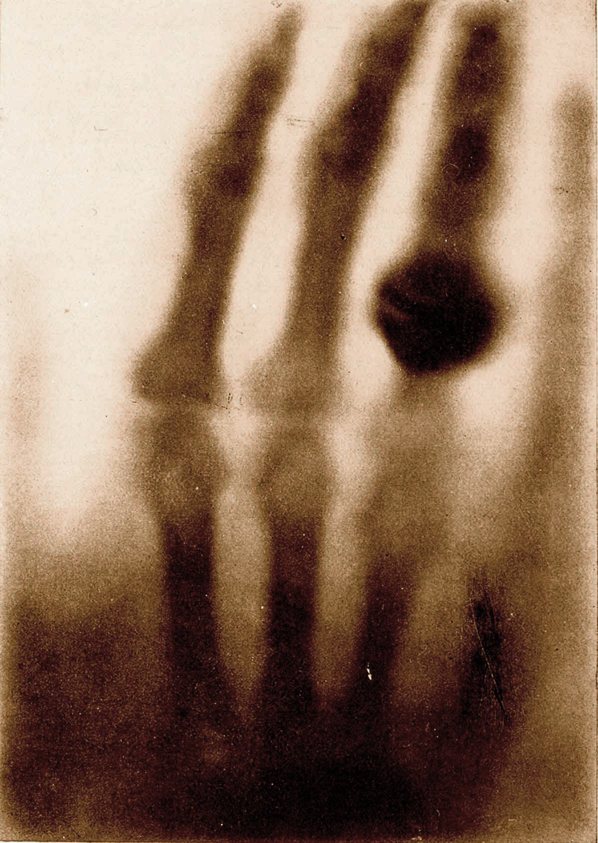 La première photographie aux rayons X