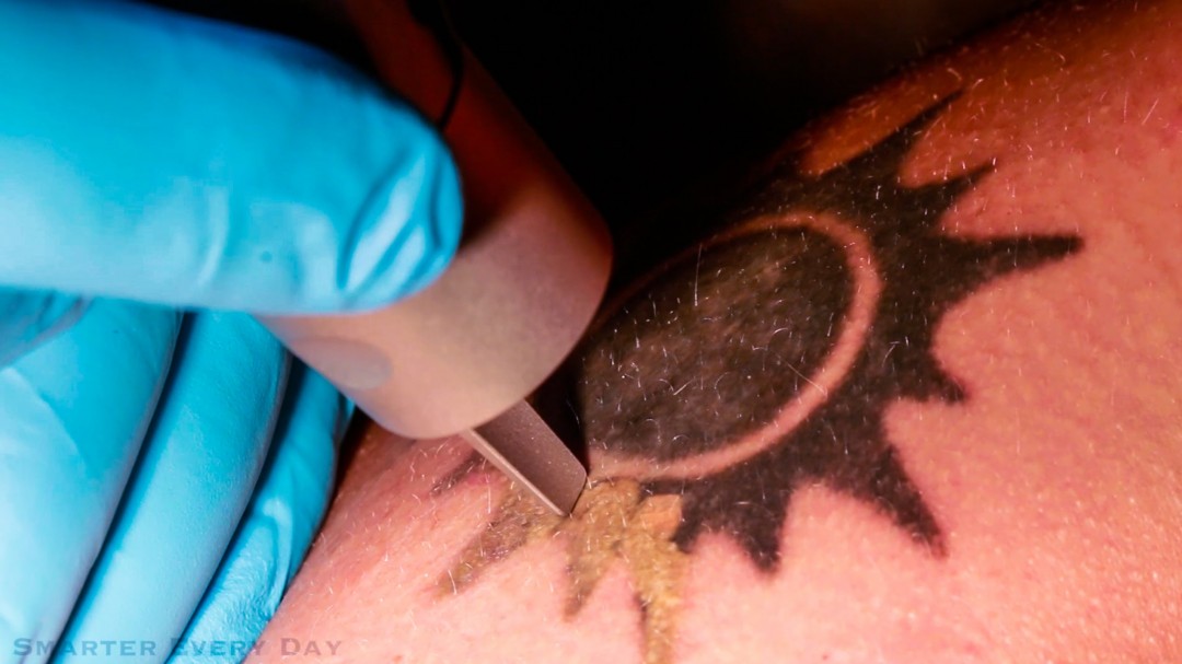 La science derrière l’effacement des tatouages au laser